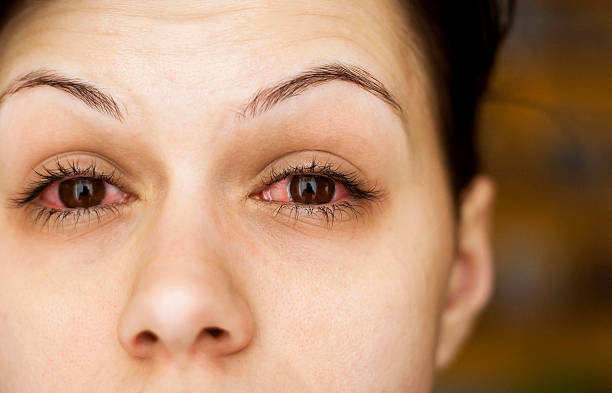 common eye conditions