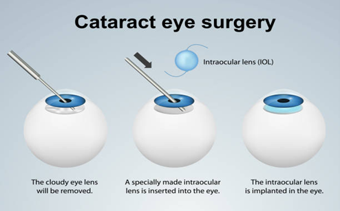 cataract eye surgery cataract-eye-surgery